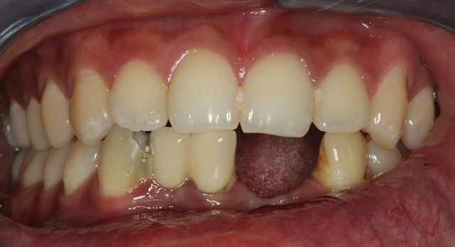 Finished Freshman Year In Pain