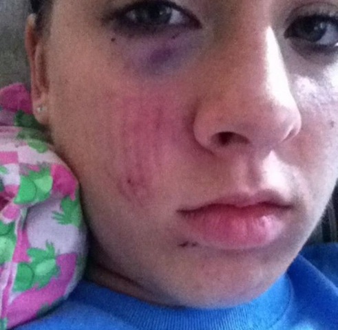 Getting bit in the face by a pit bull