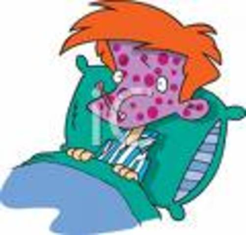 My first ever chicken pox