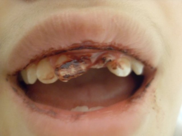 BROKE MY 2 FRONT TEETH!!
