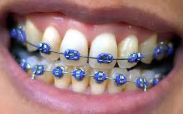 Got braces