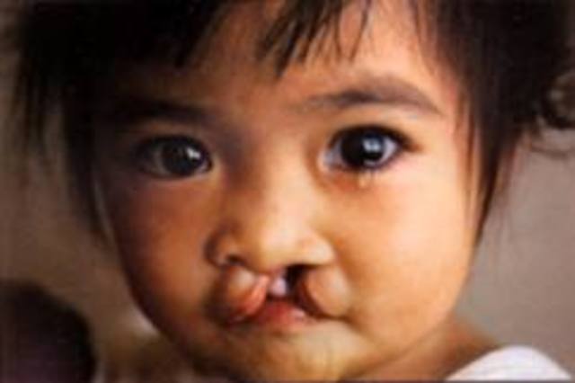 Hassan has his surgery