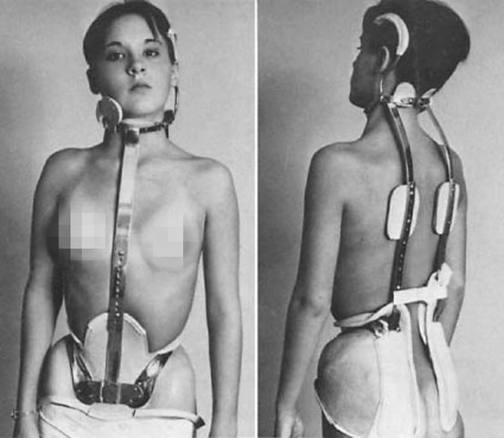 Started Wearing a Back Brace (Biosocial)