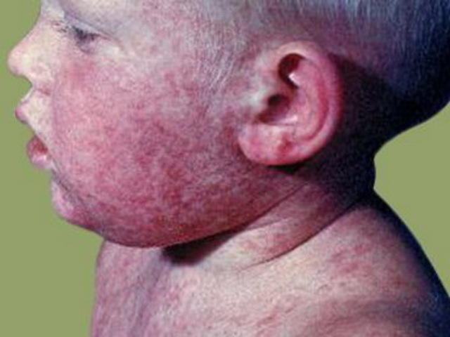 First Vaccine for Rubella