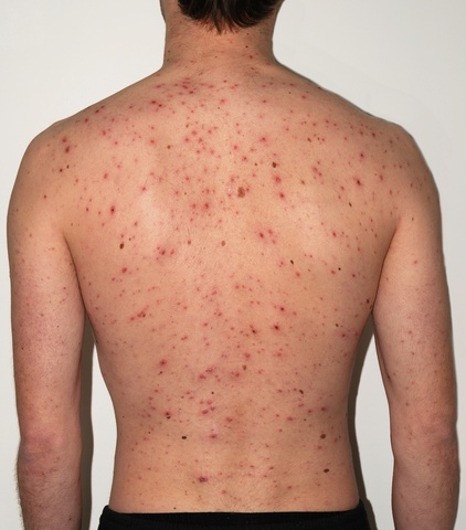 First Vaccine for Chicken Pox