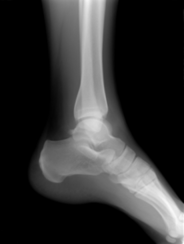 Broken Ankle / Physical Health