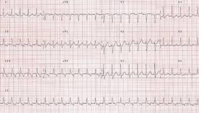 Diagnostico de enfermedad en el Corazón.