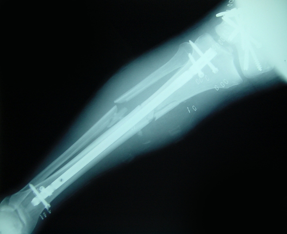 Lochie Broke his leg