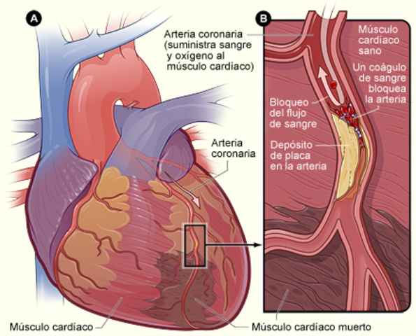 Infarto de miocardio y su diagnostico primera parte