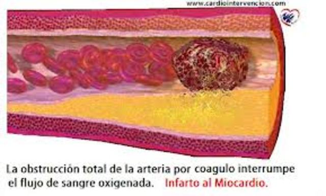 Infarto de miocardio y su diagnostico segunda parte