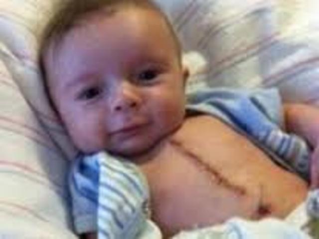 Los niños azules son operados