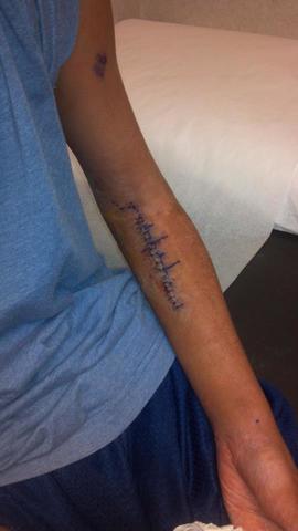 Broke my arm and had surgery