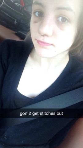 Stitches out, yeeeah.