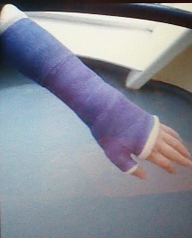 Broke my arm 5 years old