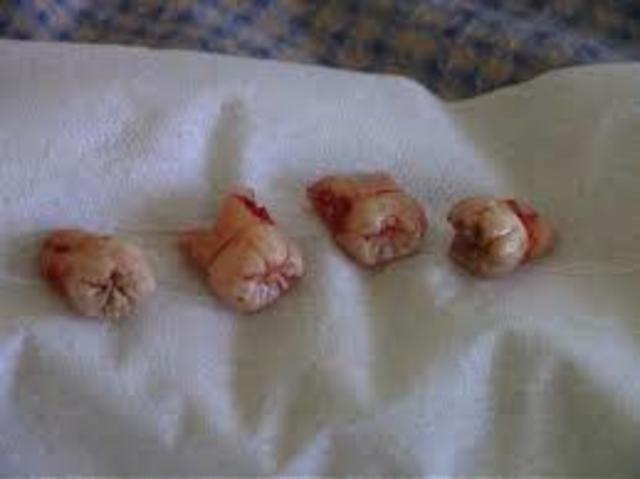 got my widsdom teeth out