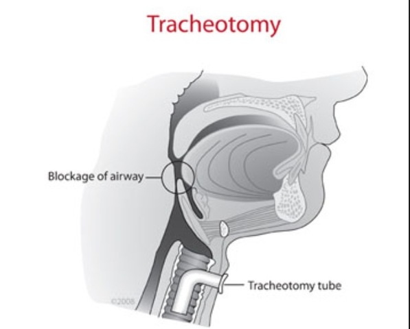 Tracheotomy