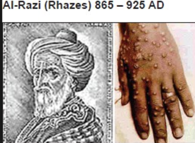 Rhazes discovered diffrence between smallpox and measles.