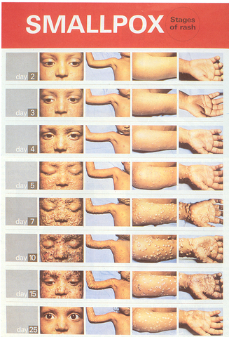 Small Pox Epidimic Renaissance