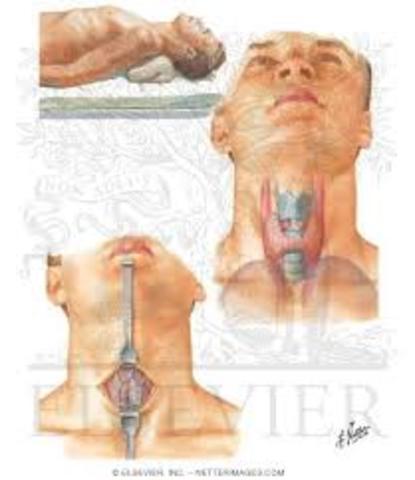 Galen tracheotomy