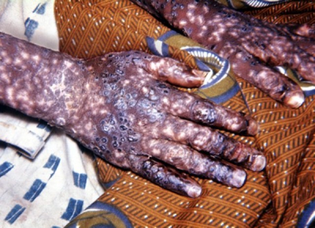 Rhazes Discovered Difference between smallpox and measles