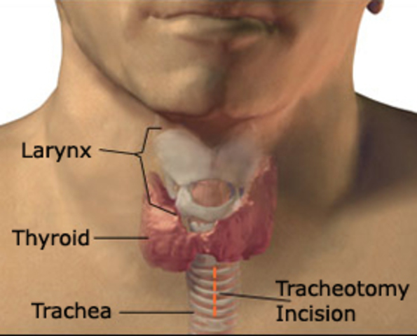 Galen Tracheotomy