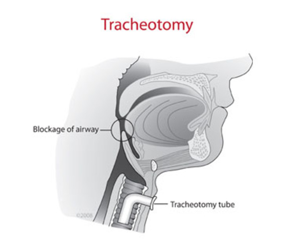 Galen;tracheotomy
