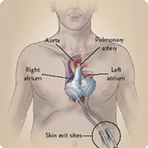 The first FDA approved artificial heart placed in patient