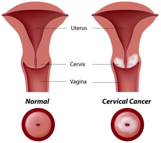 prevent cervical cancer