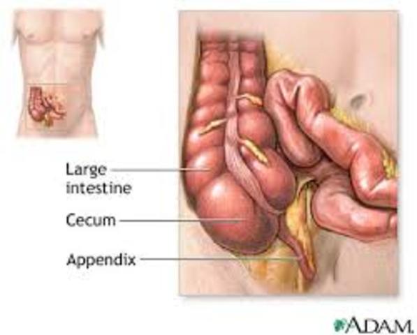 Appendectomy