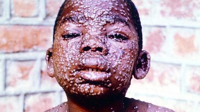 WHO declares smallpox eradicated