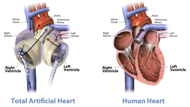 The first FDA approved implanted AbioCor artificial heart placed in a patient