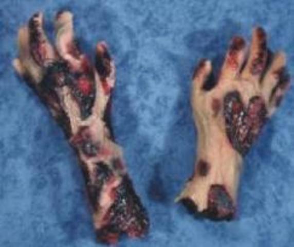 Percy Faith burns hands