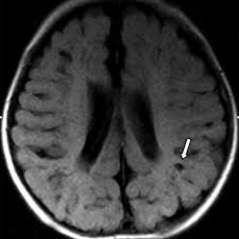 The afects of adolescent drinking