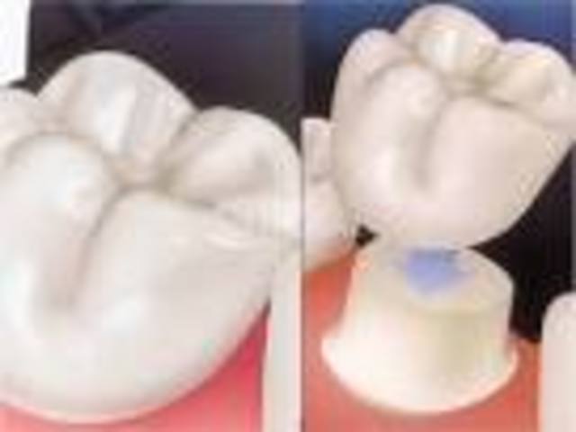 Porcelain jacket crown