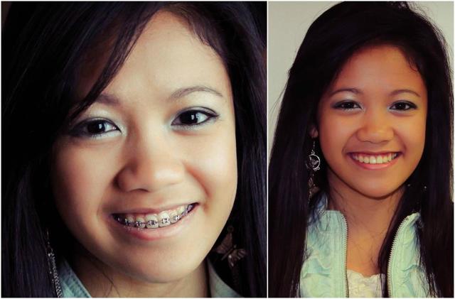 Braces for two years!!