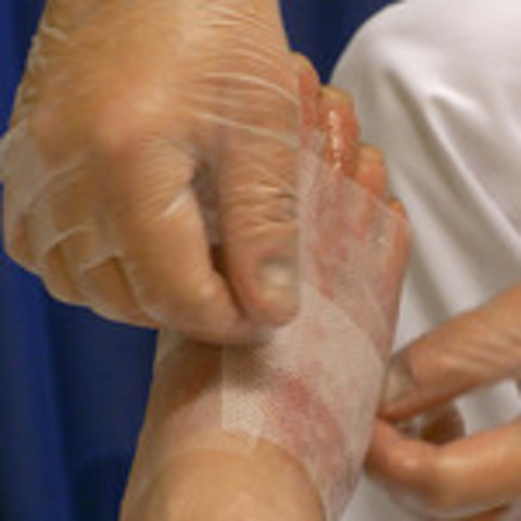 Redovisning brännskador