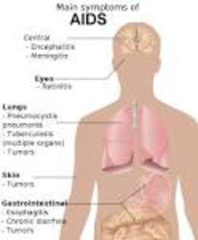 AIDS/HIV