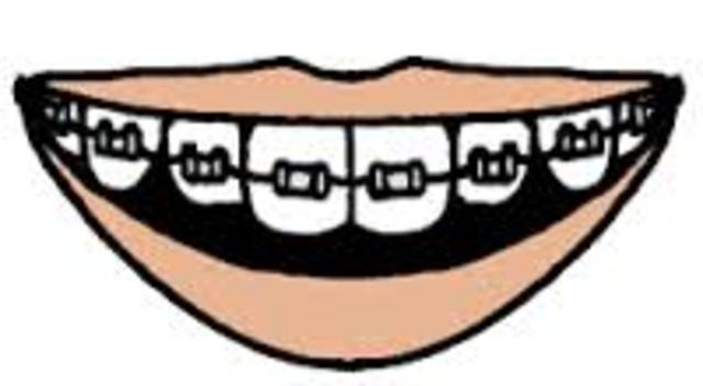 Me pusieron frenillos en 2011. Era invierno y era frio. Un cancion de moda era 'Rolling in the Deep' de Adele.