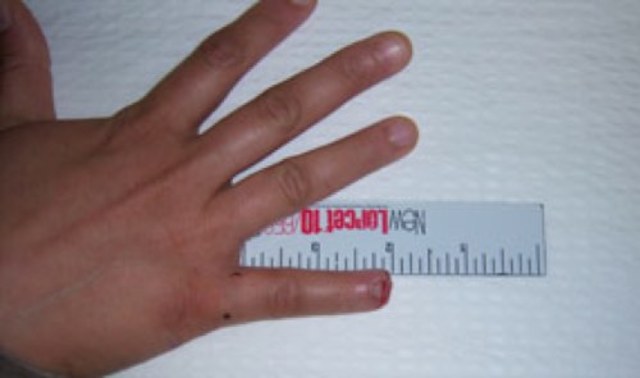 1/2 my pinkie was slammed off in a door