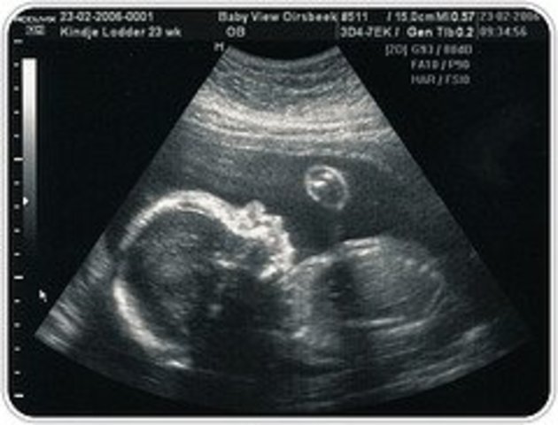 Mi primera ecografía