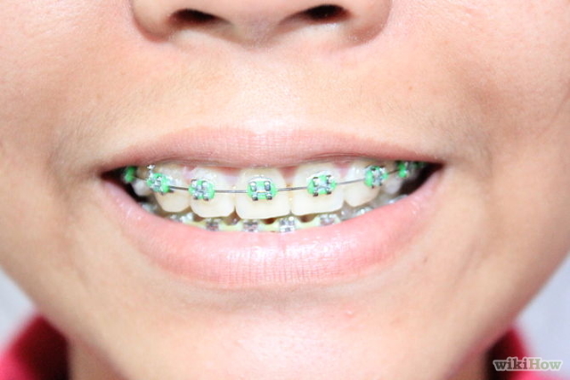 The Day I Got Braces