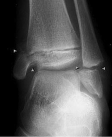 I broke my growth plate in my ankle