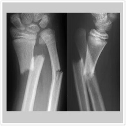 Arm fracture