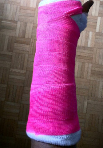 Broken Arm