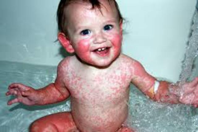 My Allergic Reaction