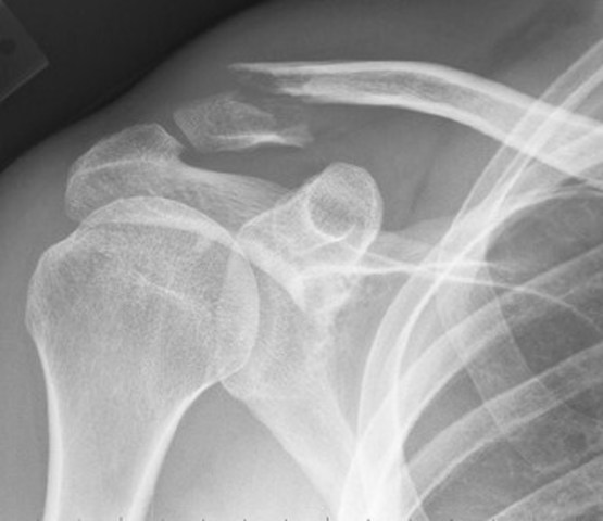 Breaking my First Bone