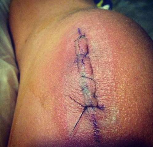 Knee Surgery
