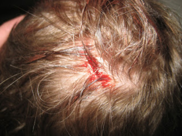 Cracking Open my Head