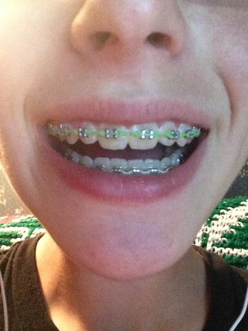 Braces