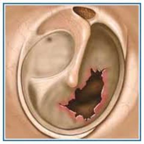 My Eardrum Exploding